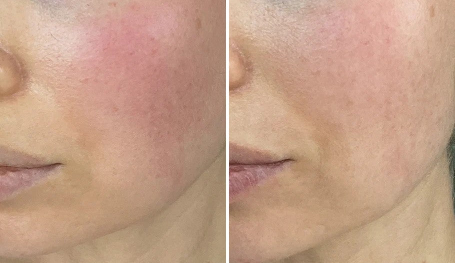 How Niche Café Biotics Can Support Skin & Gut Health for Rosacea - and Why Skincare Matters Too